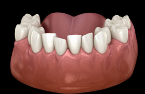 Illustration of teeth in lower arch crowded together