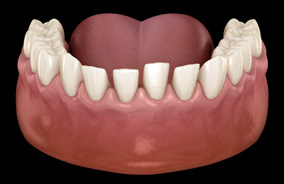 Illustration of teeth in lower arch spaced too far apart
