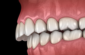 Illustration of overbite viewed from the side