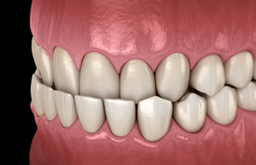 Illustration of underbite viewed close up