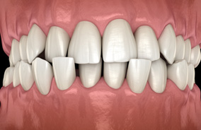 Illustration of head-on view of crossbite