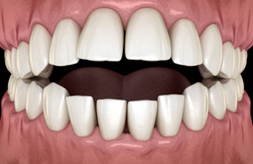 Illustration of open bite viewed from front