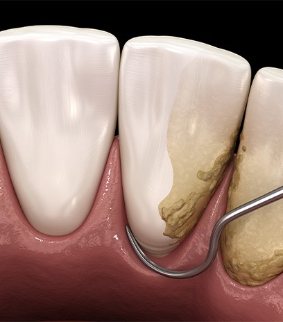 Illustration of scaling and root planing for gum disease treatment in Belmont, MA