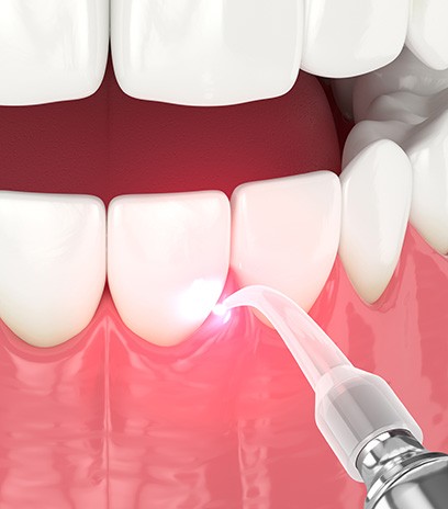 Close-up of gums being treated with laser dentistry in Belmont, MA