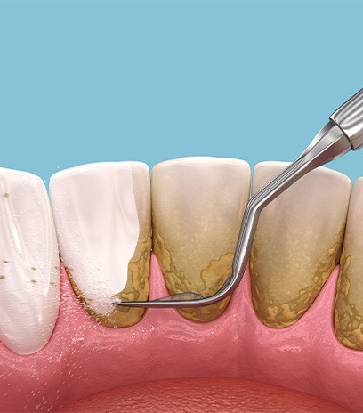 Performing scaling and root planing on back of teeth