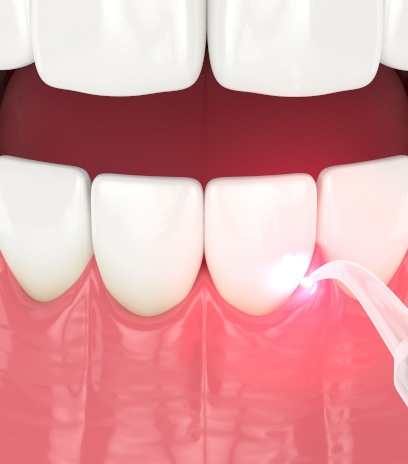 Illustration of laser treatment for the gums