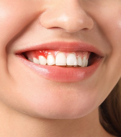 Smiling woman with signs of gum disease